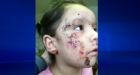 Kashechewan children suffering from rashes, open sores | CTV News