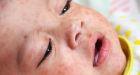 Measles rises globally amid vaccination crash; WHO and CDC sound the alarm