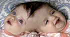B.C.'s conjoined twins to undergo vital surgery