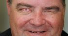 Blind man sees wife for first time after having a tooth implanted into his eye