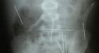 Brazil boy found with 40 needles in 'black magic rite'