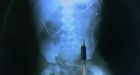 Needles removed from Brazilian boy