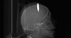 US military doctor removes live ammo from head of Afghan soldier
