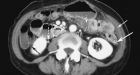 Woman's colon removed after misread CT scan: suit
