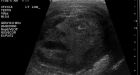 Here's looking at you: Doctors find face in testicle ultrasound