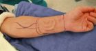New ear grown on woman's arm