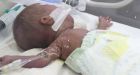 World's smallest baby' Premature boy born weighing just 1lb survives