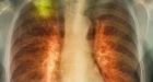 Cuba Has a Lung Cancer VaccineAnd America Wants It