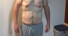 Winnipeg man fundraising for excess skin surgery after losing 200 pounds
